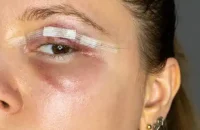 Blepharoplasty-aftercare1.webp