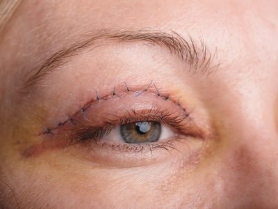 Blepharoplasty-post-surgery.jpeg