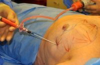 Fat-Transfer-Surgery3.jpg