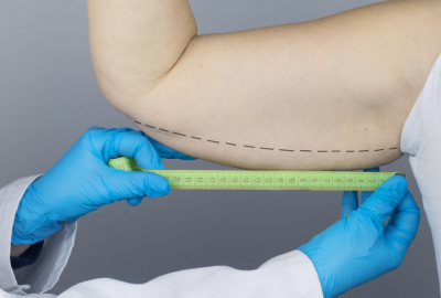 arm-lift-surgery-procedure.png