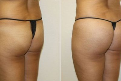 buttocks-enhancement-surgery.jpg