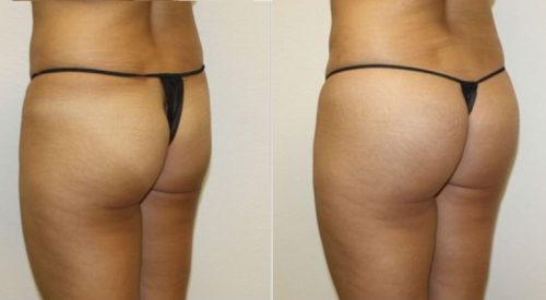 buttocks-enhancement-surgery.jpg