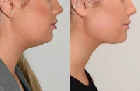 double-chin-reduction10.webp