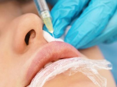 lip lift surgery (1)