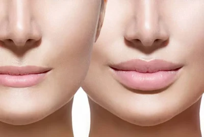 lip lift surgery (1)