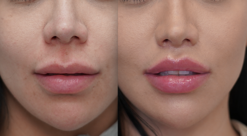 lip lift surgery (1)