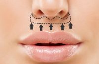lip lift surgery (3)