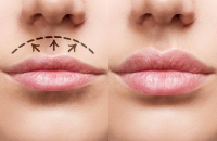 lip lift surgery after care (2)