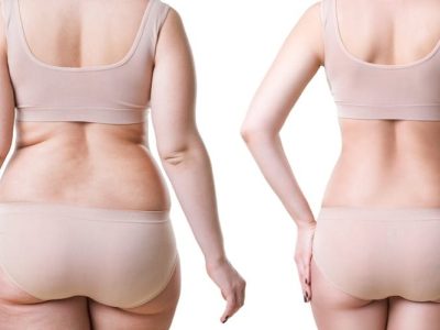 liposuction-post-surgery1.jpg