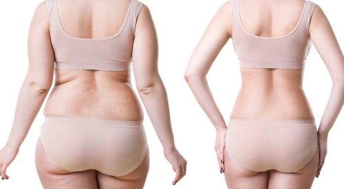 liposuction-post-surgery1.jpg