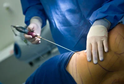 liposuction-surgery.webp