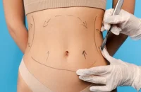 liposuction-surgery1.webp