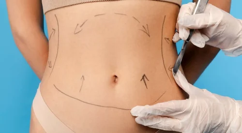 liposuction-surgery1.webp