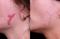 scar removal (1)