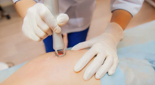 scar removal (2)