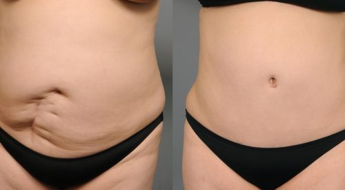scar removal (3)