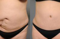 scar removal (3)