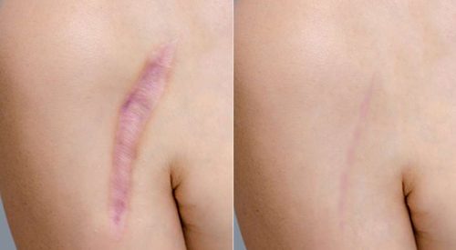 scar removal (4)