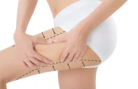 thigh-lift-surgery-consultation.webp