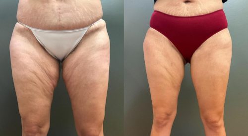 thigh-lift-surgery1.jpg